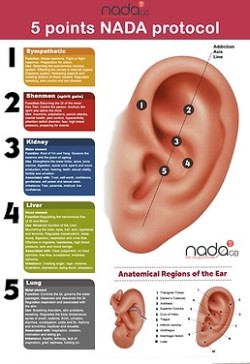 Taster Session of Auricular Acupuncture